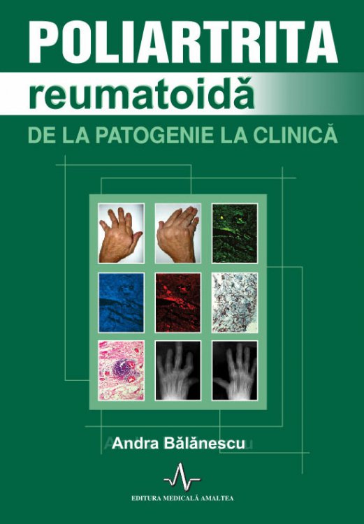 poliartrita reumatoida carte artrita osului genunchiului